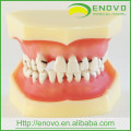 DE-L4 Peridontale Disease Dental Modell mit abnehmbarem weichem Zahnfleisch